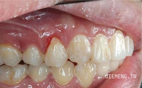 梦见掉大牙没出血